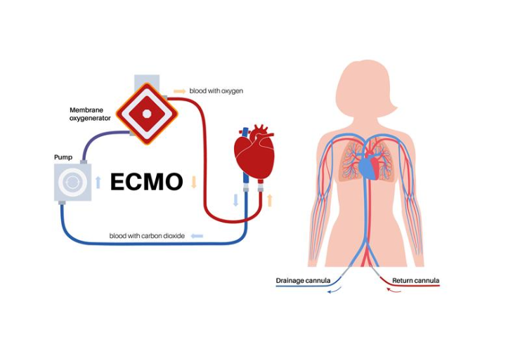 Heart Failure Management and ECMO Support